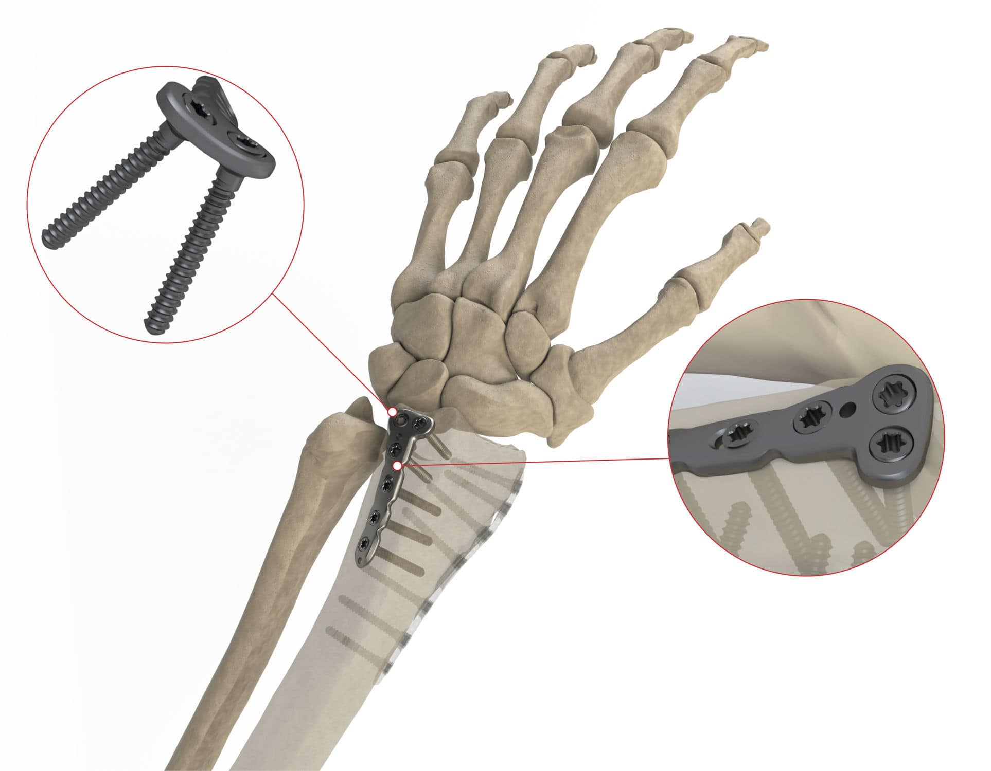 Plaque De Compression De Radius AS W 014 Ases Orthopedics Distale