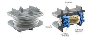 prothèse de disque cervical