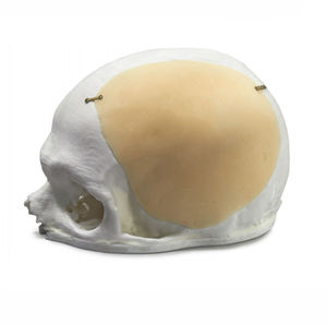 implant crânien sur mesure