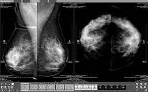 logiciel de diagnostic / d'analyse / pour mammographie