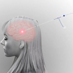 système d'ablation laser pour traitement des tumeurs cérébrales / guidé par IRM