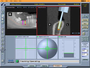 système de navigation chirurgicale optique / pour chirurgie maxillo-faciale
