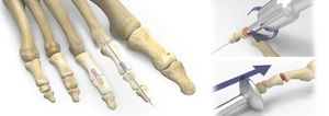 vis de compression à os arthrodèse de l'articulation interphalangienne du pied / canulée