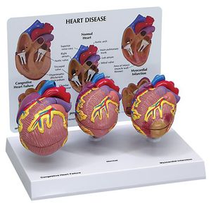 modèle anatomique coeur / pathologique / en kit