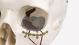implant périorbital