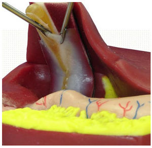 modèle anatomique de vésicule biliaire / de cholécystectomie