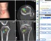 Logiciels de navigation pour chirurgie orthopédique