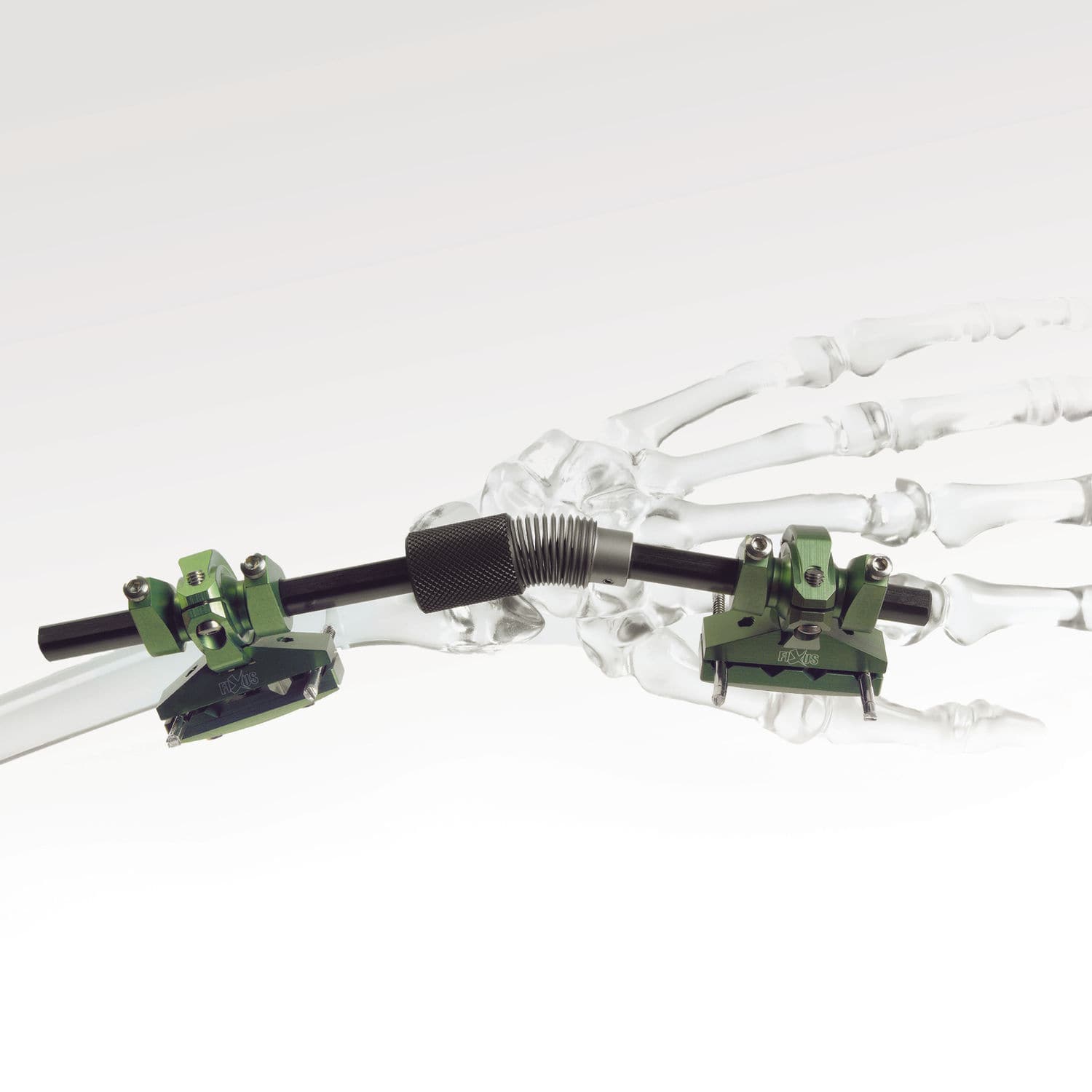 Fixateur Externe Orthopédique à Trois Axes - Pour Allongement Et Correction Osseuse, Rouge