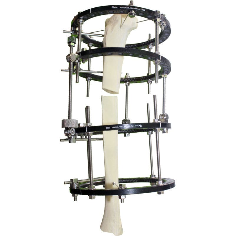 Fixateur externe de tibia ptBR Selaz circulaire Fixateur externe de tibia ptBR Selaz circulaire