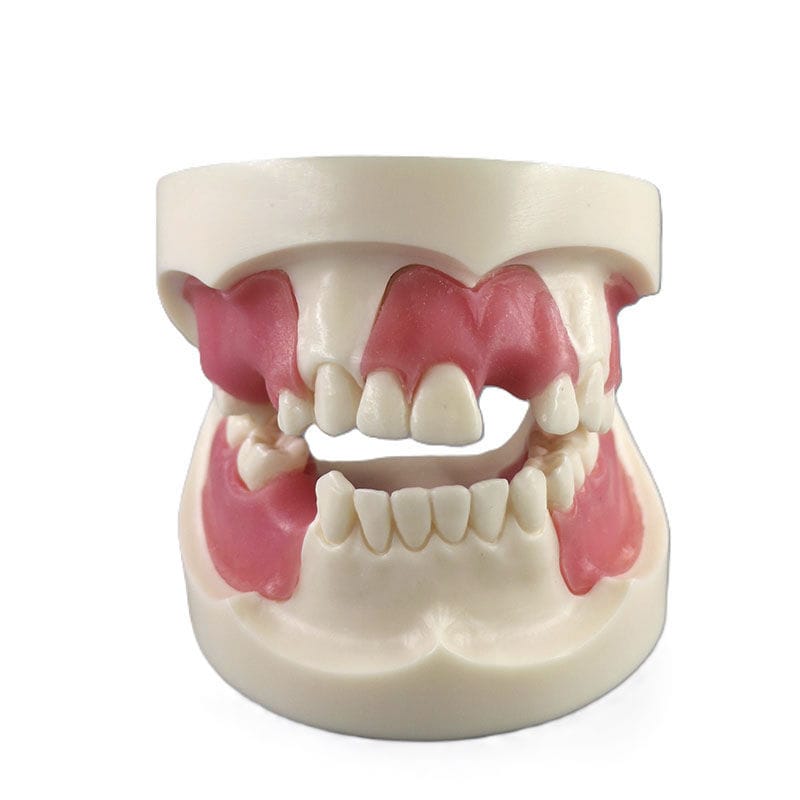 Modèle Dentaire Pratique Pour Implants - Typodont Avec Gencives Souples, Idéal Pour études Dentaires