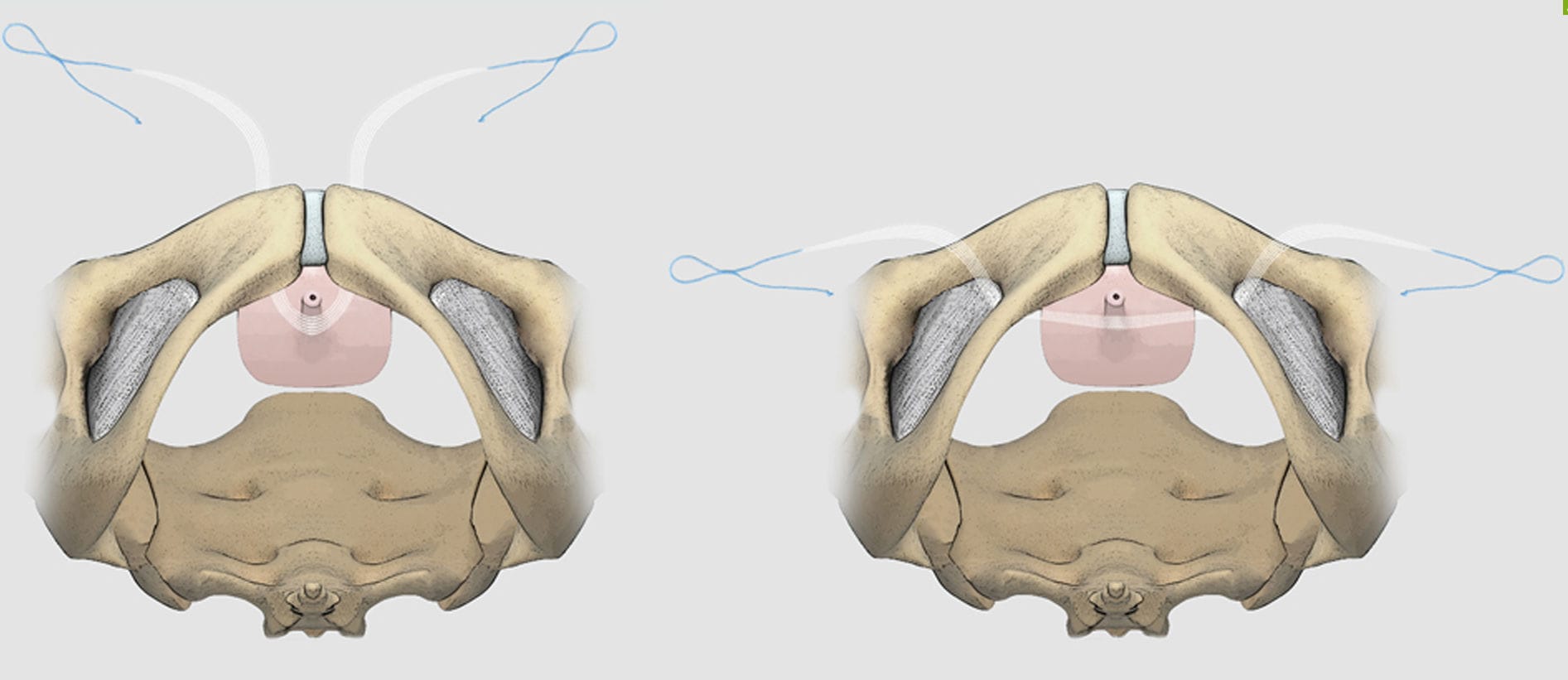 Bandelette de reconstruction pour l'incontinence urinaire Lift