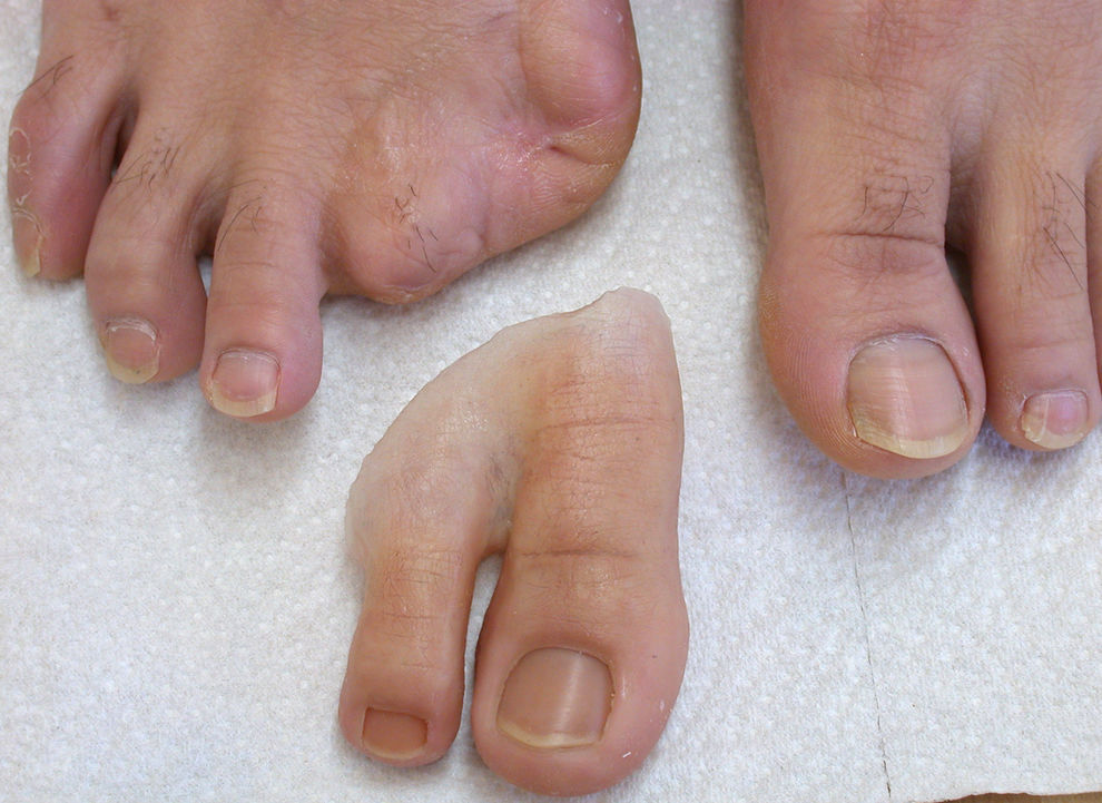 Épithèse orteil - Aesthetic Prosthetics - adulte
