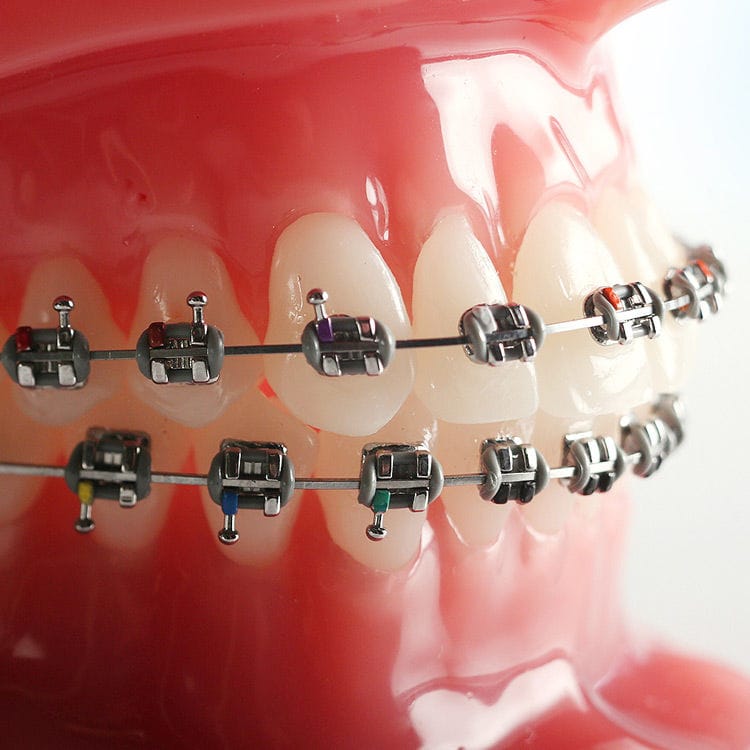Bracket orthodontique en métal miniPrevail® G&H Orthodontics twin