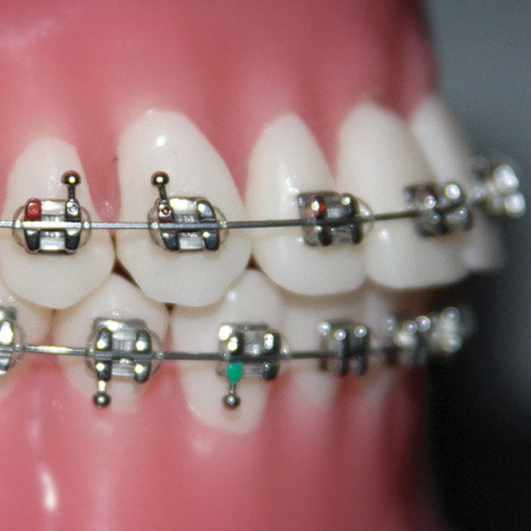 Bracket orthodontique en métal Focus™ G&H Orthodontics mini