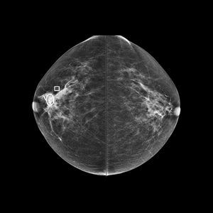 algorithme pour mammographie