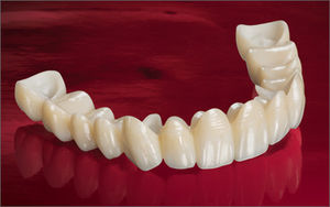 couronne dentaire en zircone