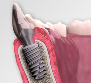 implant dentaire conique
