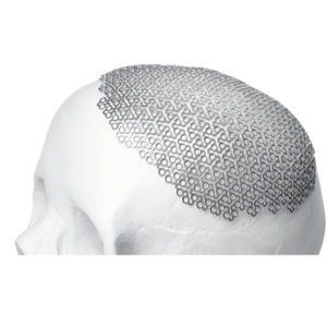 implant crânien
