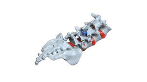 implant vertébral interépineux lombaire