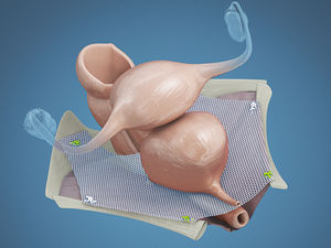 bandelette de reconstruction pour les prolapsus