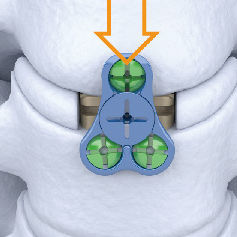 cage intersomatique cervicale