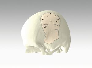 implant crânien sur mesure