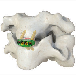 cage intersomatique cervicale