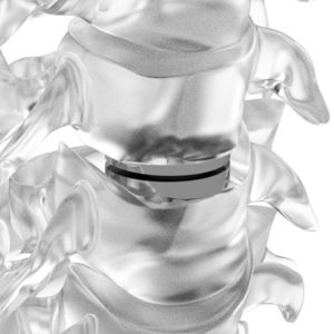 prothèse discale cervicale