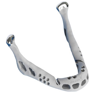 implant mandibulaire sur mesure