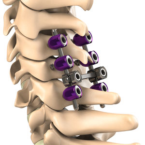 système d’ostéosynthèse cervical