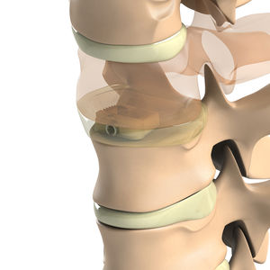 cage intersomatique cervicale