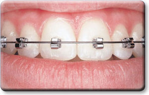 bracket orthodontique autoligaturant / mini
