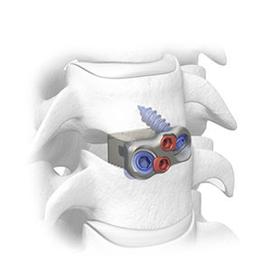 cage intersomatique cervicale