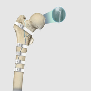fil de cerclage orthopédique pour révision de prothèse de hanche