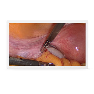 écran d'endoscopie