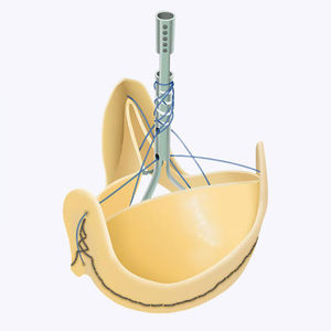 bioprothèse valvulaire aortique