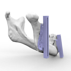 gabarit de résection pour reconstruction maxillo-faciale