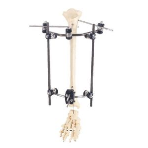 fixateur externe de tibia