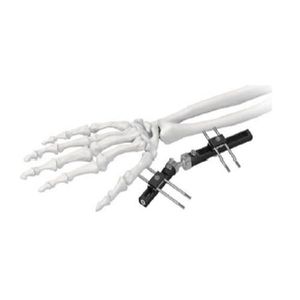 fixateur externe de poignet