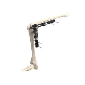 fixateur externe de genou