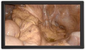 écran pour ophtalmologie
