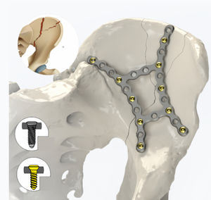 plaque de compression de pelvis