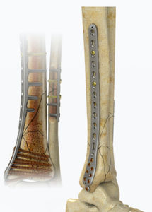 plaque de compression de tibia