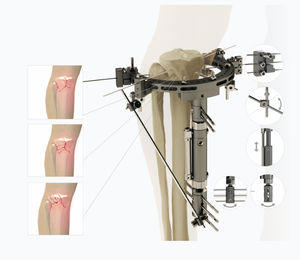 fixateur externe de tibia