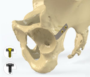 plaque de compression d'acetabulum