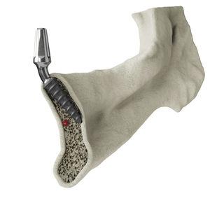 implant dentaire conique
