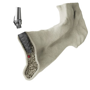 implant dentaire conique