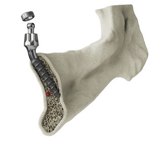 implant dentaire conique