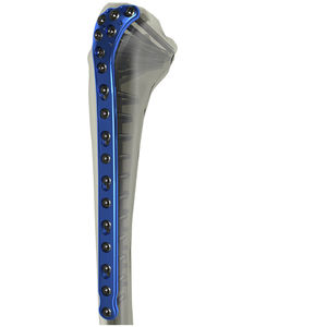 plaque de compression de tibia