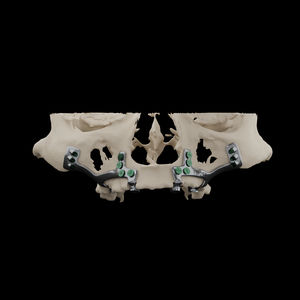 implant dentaire en titane